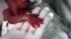 Study: Premature Babies Often Catch Up to Peers in School 