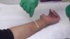 Eczema Treatment During Infancy Helps Prevent Asthma, Allergies