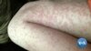 Infectious diseases like measles were once considered under control in developed countries, but now the World Health Organization warns that we could be facing a global measles outbreak. 